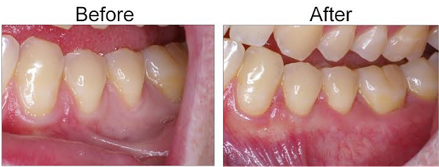 connective tissue graft