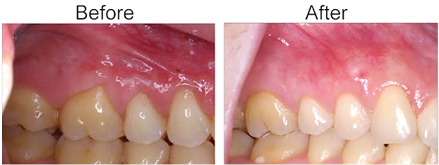 2 connective tissue graft