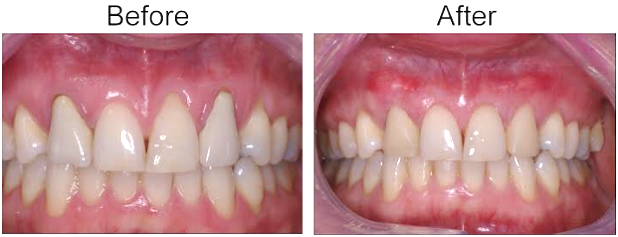 3 connective tissue graft